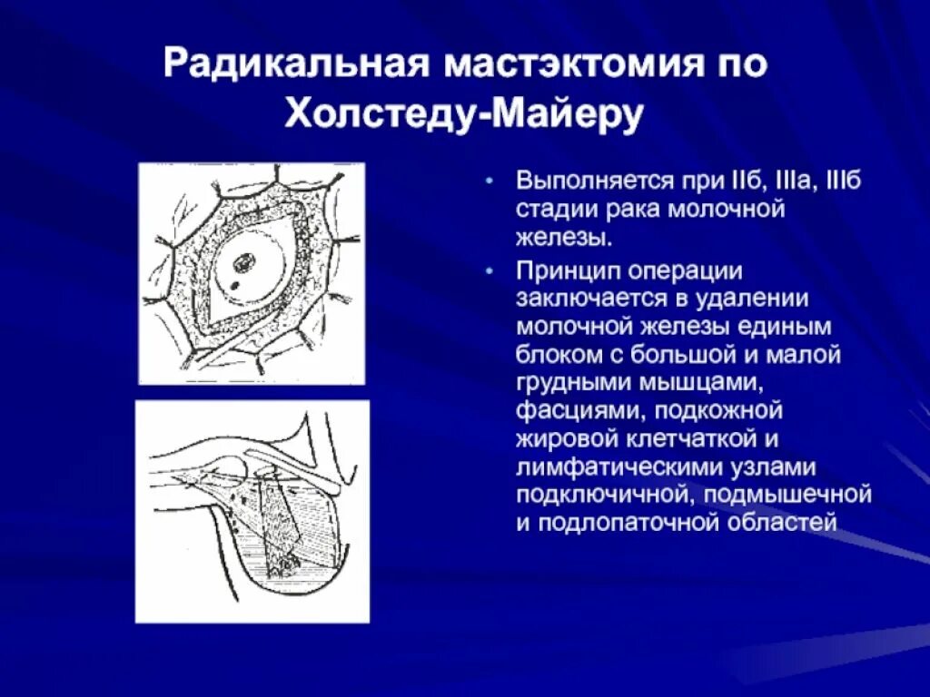 После операции молочной железы и лимфоузлов. Секторальная резекция молочной железы хирургия. Радикальная мастэктомия по Холстеду Майеру. Операция - радикальная мастэктомия (по Холстеду-Майеру). Радикальная секторальная резекция молочной железы.