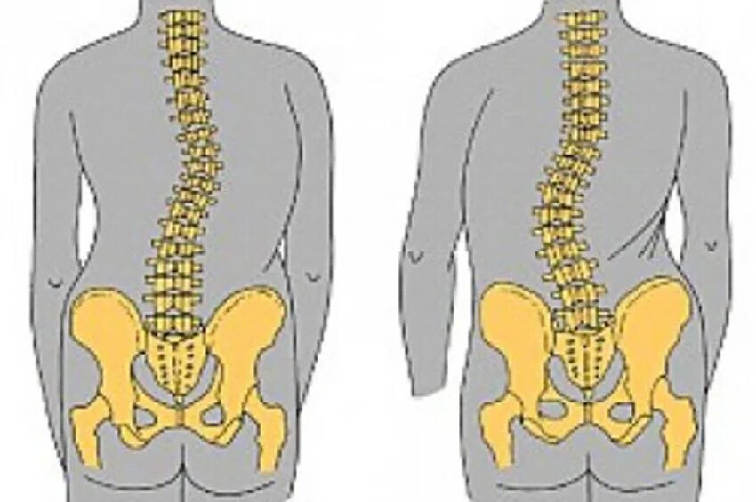 Левосторонний поясничный сколиоз. Левосторонний сколиоз поясничного отдела позвоночника. Сколиоз поясничного отдела позвоночного столба 1 степени. Движения поясничного отдела позвоночника