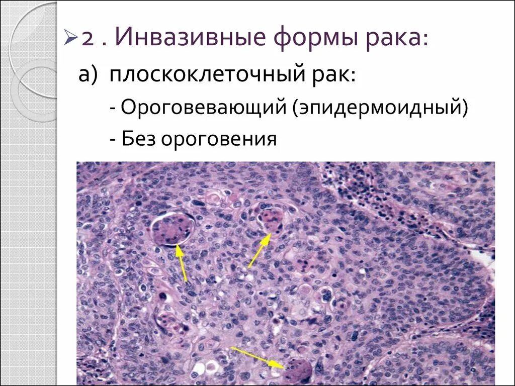 Плоскоклеточный неороговевающий. Вульварная плоскоклеточная аденокарцинома. Плоскоклеточная карцинома g2. Плоскоклеточная неороговевающая карцинома. Умеренно дифференцированный плоскоклеточный рак