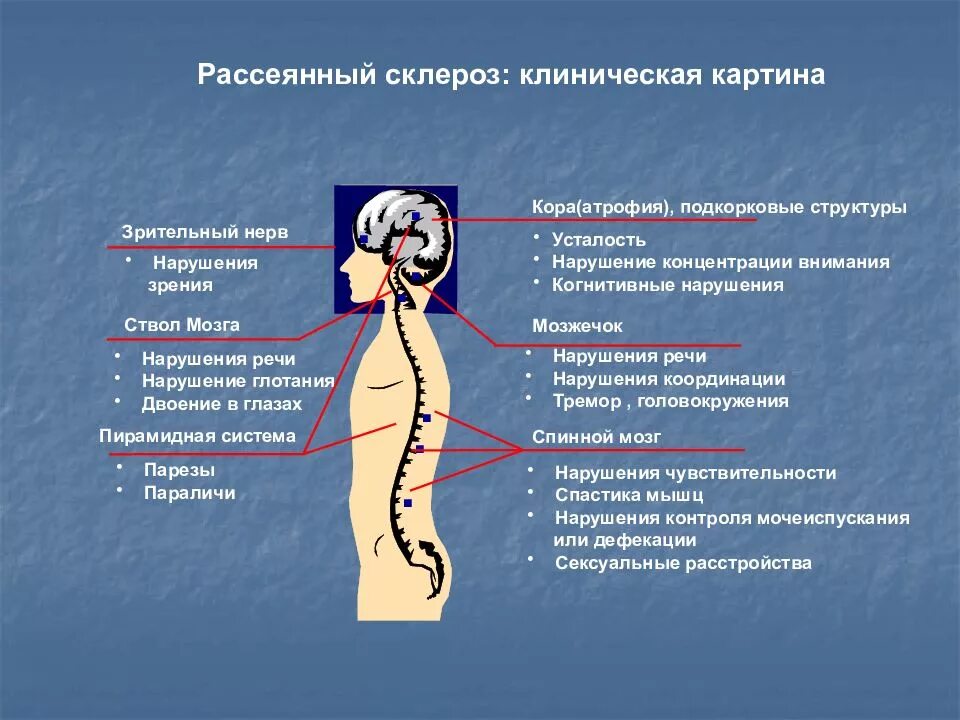 Сколько живет нерв. Рассеянный склероз. Симптомы рассеянного склероза. Клинические проявления рассеянного склероза. Симптомы рассеянного склероза у женщин.