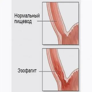 Эзофагит терапия