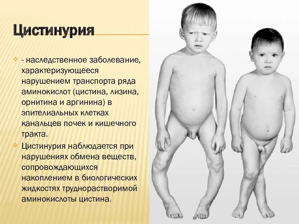 Рахит курсовая работа. Наследственные заболевания рахит. цистинурия.