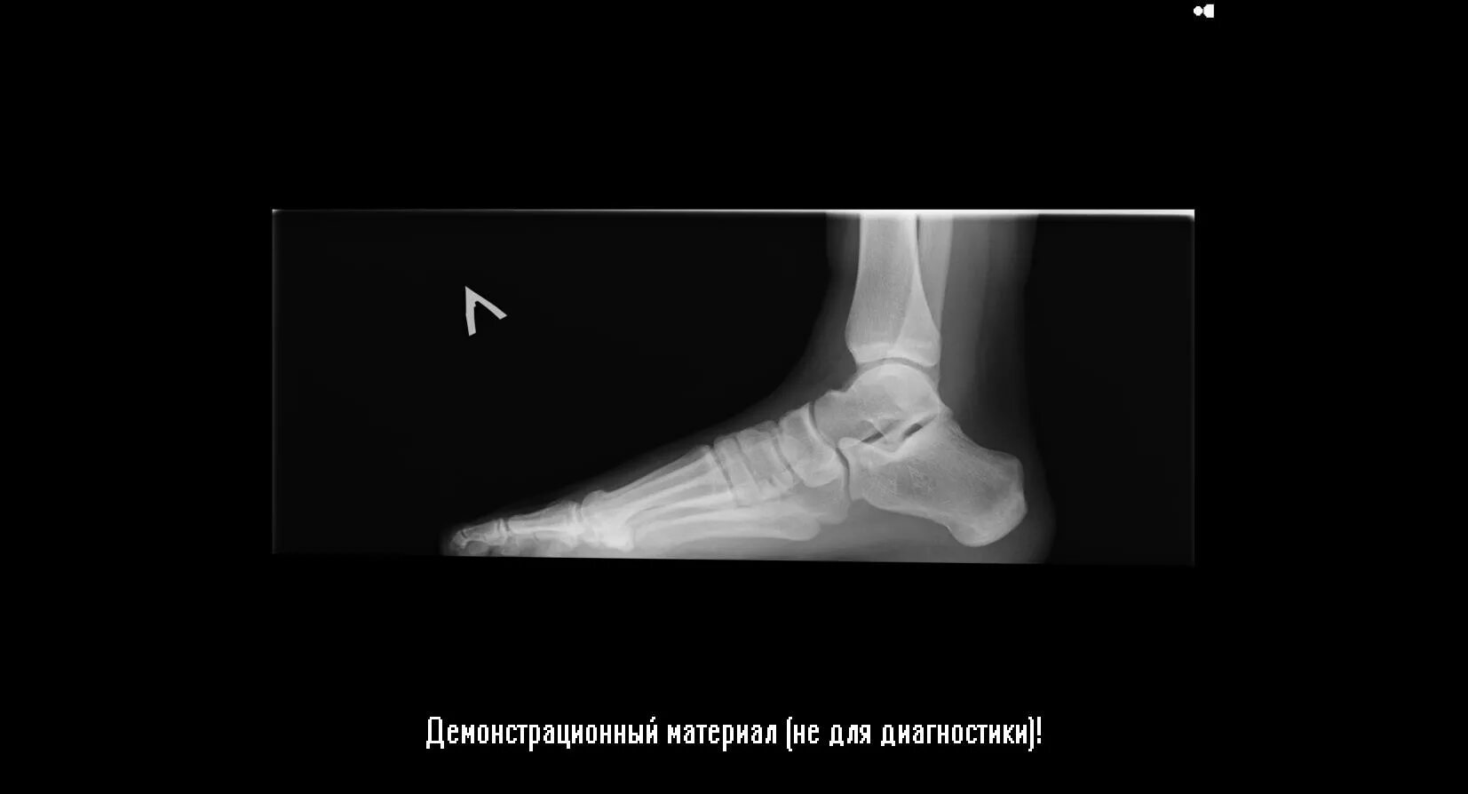Плоскостопие 3 степени инвалидность. Плоскостопие 3 степени градусы. плоскостопие 3 степени снимки. плоскостопие 3 степени фото.