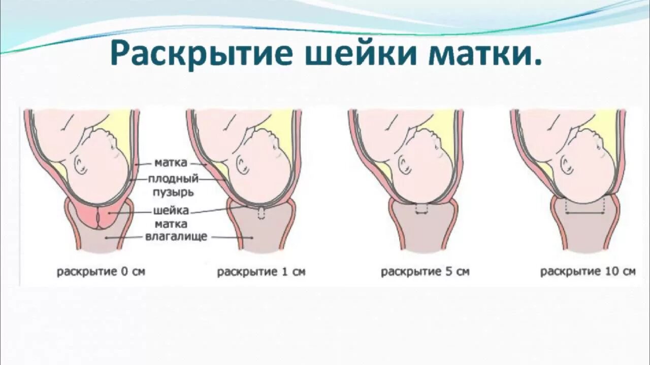 Схватки без пробки. Этапы раскрытия шейки матки в родах. Периоды родов раскрытие шейки матки у повторнородящих. Шейка матки при беременности раскрытие. Раскрытие шейной матки.