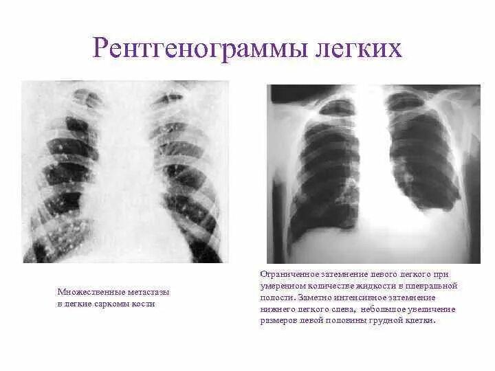 Метастазы в легких терапия. Метастатическое поражение легких рентген. метастазы в легкие рентген. множественные метастазы в легких. метастазы в легкие на рентгенограмме.