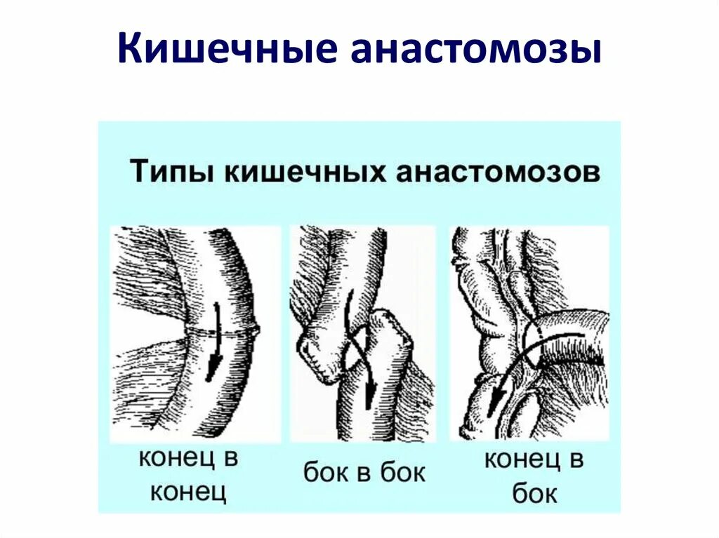 Кишечные швы и типы анастомозов. Кишечный анастомоз швы. Резекция тонкой кишки схема. Анастомозит что это