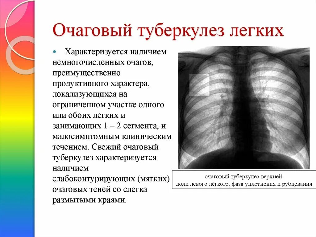 Очаговый туберкулез симптомы рентген. Очаговая форма туберкулеза рентген. Очаговый туберкулез легких в фазе инфильтрации рентген. Очаговый туберкулез рентген признаки. Диагноз с 2 легкого