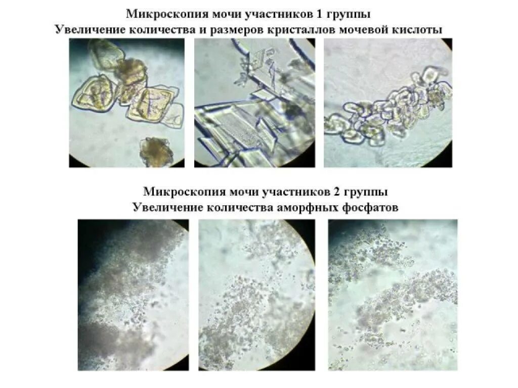 Фосфаты в какой моче. Кристаллы мочевой кислоты микроскопия. Аморфные фосфаты микроскопия мочи. Микроскопия мочевого осадка. Соли мочевой кислоты микроскопия.