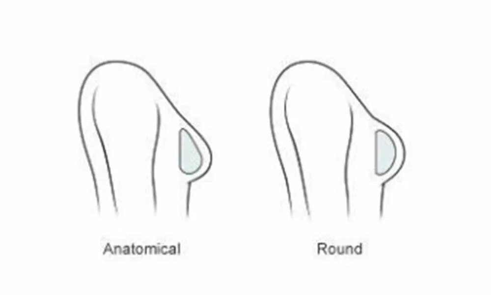 В отличии от круглых. Анатомическая форма грудных имплантов и круглых. Имплант груди анатомической формы. Импланты грудные анатомические и круглые. Формы имплантов груди разница.