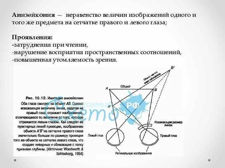 Анизометропия это в офтальмологии. Анизейкония это офтальмология. Анизометропия и анизейкония. Коррекция анизометропии. Методы коррекции анизейконии.