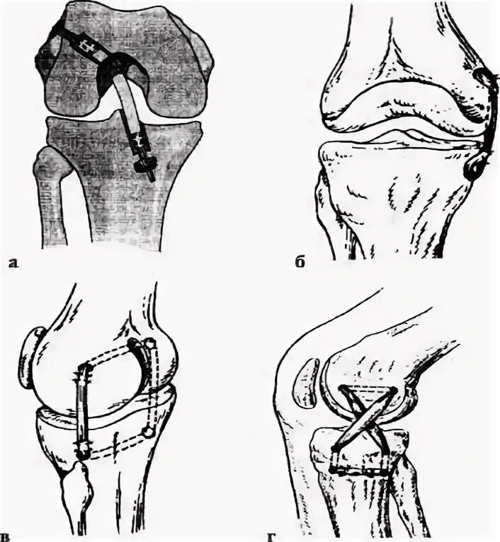 Якорная фиксация крестообразной связки коленного сустава. Разрыв ПКС коленного сустава операция. Разрыв связок коленного сустава ПКС операция. Пластика передней крестообразной связки коленного сустава методика.