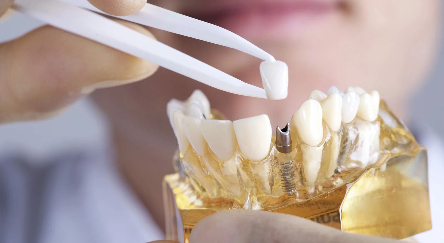 Зубной имплантат. Коронки ортопедическая стоматология. Как называется протезист
