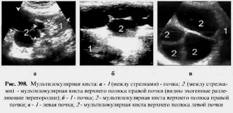 Опасные размеры кисты почки