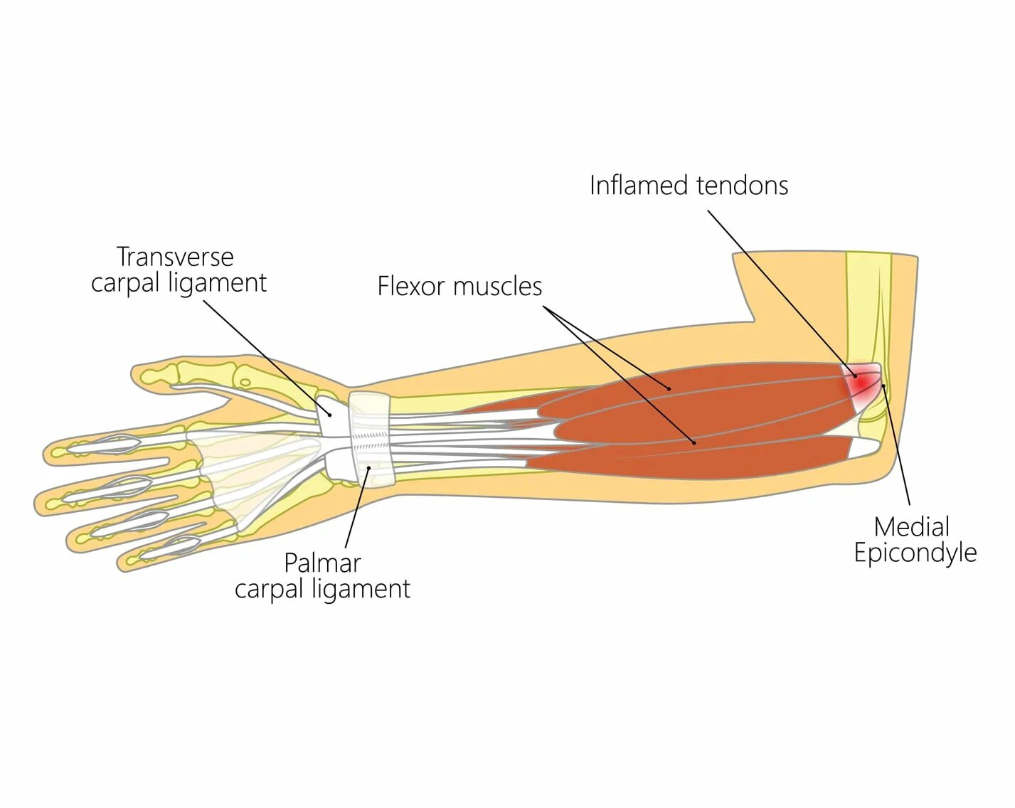 Диагностика эпикондилита. Латеральный эпикондилит локтевого сустава. Тендинит локтевого сустава. Мкб эпикондилит локтевого сустава. Воспаление локтевого сустава.