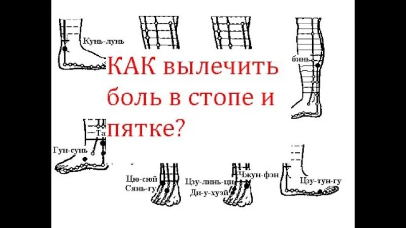 Как вылечиться от боли. Акупунктура при пяточной шпоре. акупунктура при боли в пятке. шпора на внешней стороне стопы.