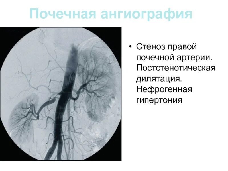 Селективная церебральная ангиография. Кт ангиография почечных артерий. Артериография почечных артерий. Аортография почечных артерий. Тромбоз почечной артерии