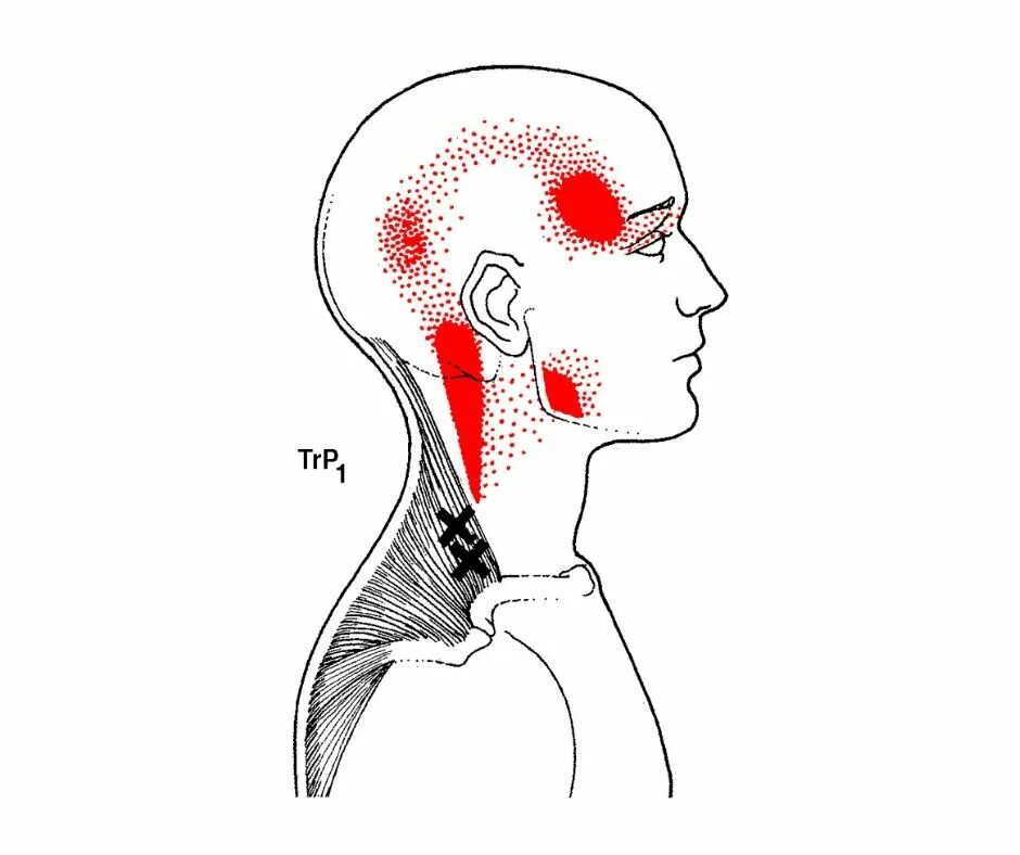 Напряжение в затылке. Миофасциальный синдром триггерные точки. Триггерные точки на голове. Миофасциальные триггерные точки шеи. Миофасциальные триггерные точки головы.