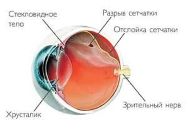 Глазное дно отслоение сетчатки. Отслоение сетчатки симптомы. Отслойка сетчатки зрение. Отслойка сетчатки на щелевой лампе.