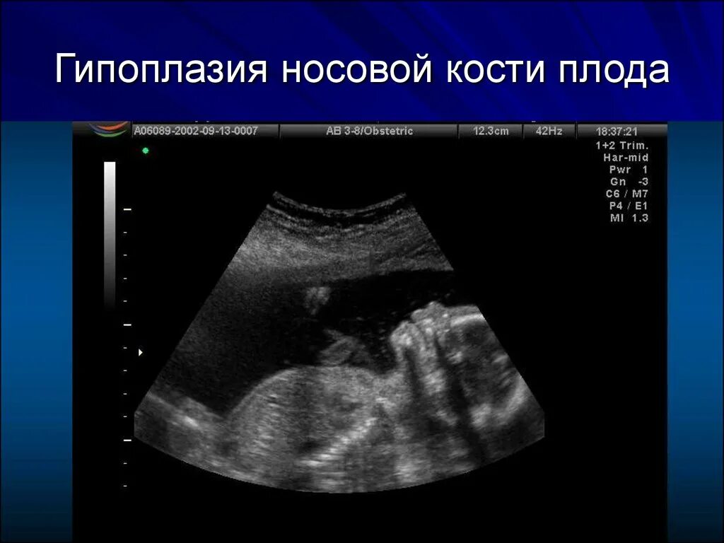 Узи аномалий. Узи носовой кости плода на 12 неделе беременности. носовая кость плода в 20 недель на узи. носовая кость на узи 20 недель. гипоплазия носовых костей по узи у плода 12 недель.