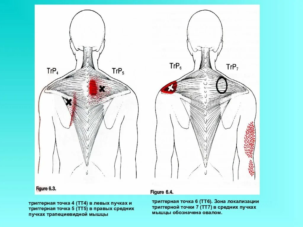 Тт1 триггерная точка. Подостная мышца триггерные точки. Трапециевидная мышца спины триггерные точки. Мышцы спины человека триггерные точки. Триггерные точки это простыми словами