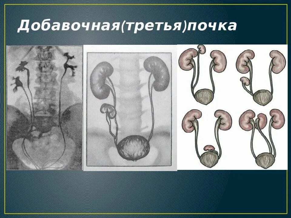 Пороки выделительной системы. Пороки развития выделительной системы. третья добавочная почка.