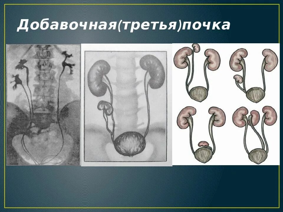 Аномалии развития мочеполовой. Порок развития выделительной системы добавочная почка.