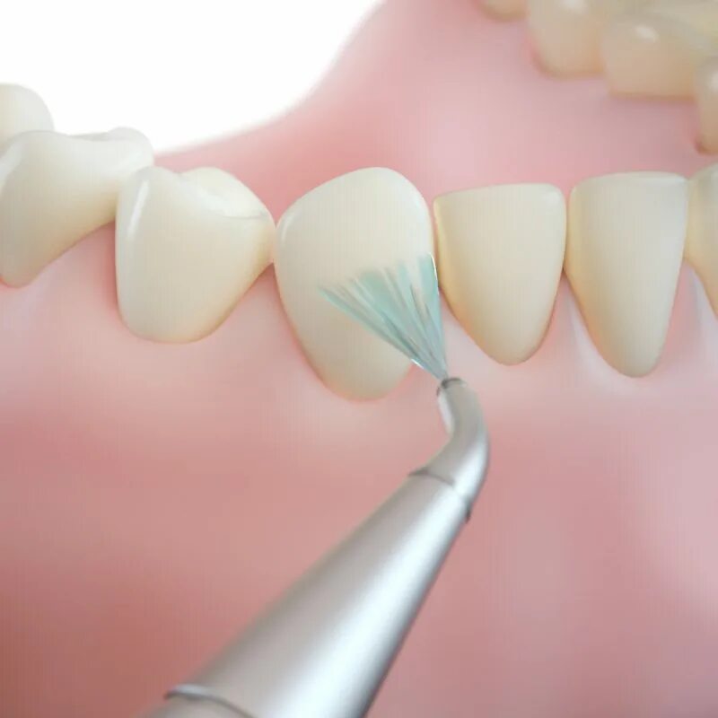 АИР флоу в стоматологии. Профессиональная гигиена зубов. Комплексная чистка зубов Air Flow+ ультразвук.