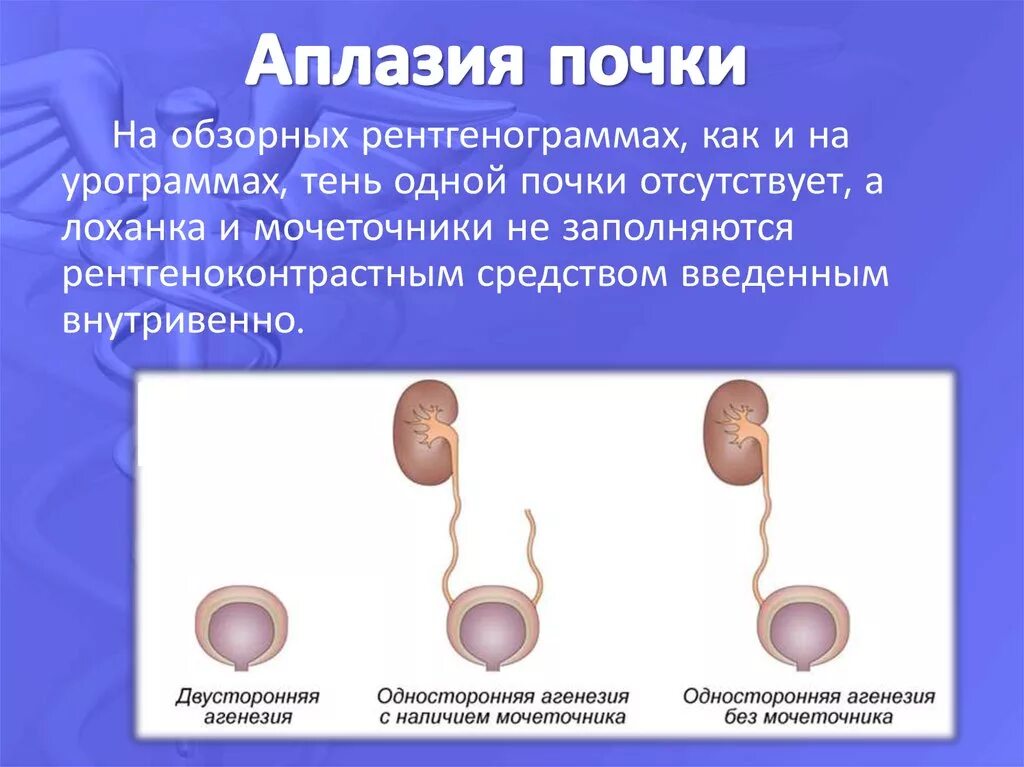 Агенезия и аплазия почки отличия. Аплазия тимуса рентген. Аплазия. Агенезия и аплазия почки. Врожденное отсутствие почки.