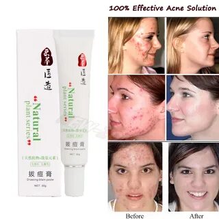 Acne removing