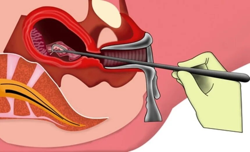 Почему после чистки нельзя. Раздельное диагностическое выскабливание полости матки. Раздельное диагностическое выскабливание слизистой оболочки матки. Хирургическое выскабливание полости матки.