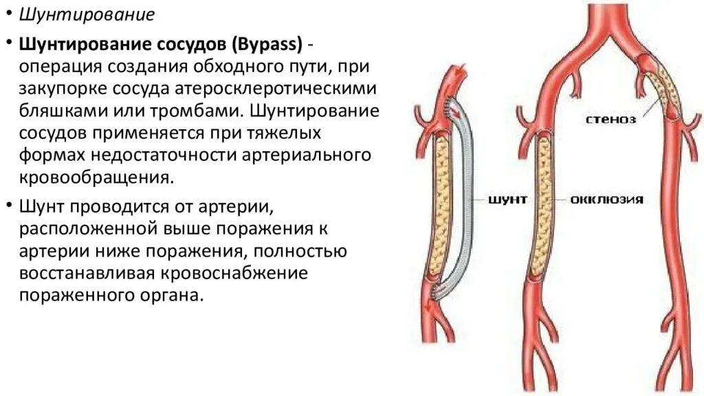 Шунтирование артериального сосуда. Шунтирование внутренней сонной артерии. Операция шунтирование артерий нижних конечностей. Шунтирование при атеросклерозе сосудов. Расширение сердечного сосуда