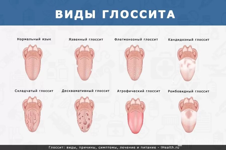 Глоссит Гюнтера Миллера. Клинико-анатомическую форму глоссита. Гунтеровский глоссит этиология. Язык за 2 недели