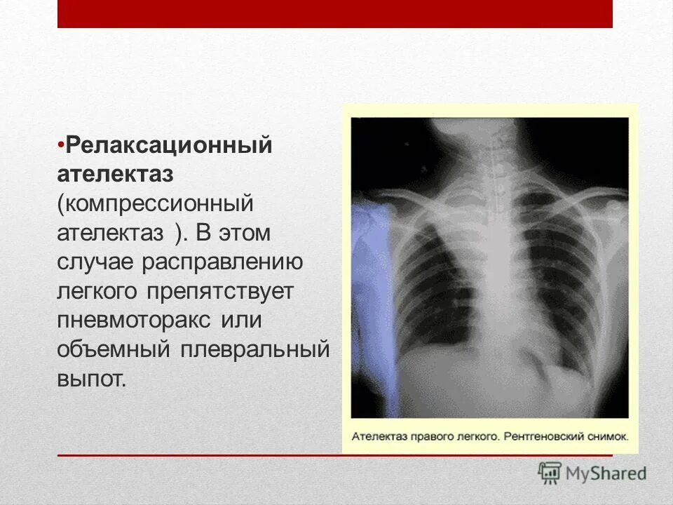 Признаки ателектаза легкого. Компрессионный ателектаз рентгенограмма. Дисковидный ателектаз на рентгене легких. Дисковидный ателектаз рентген. Ателектаз s5 правого легкого.