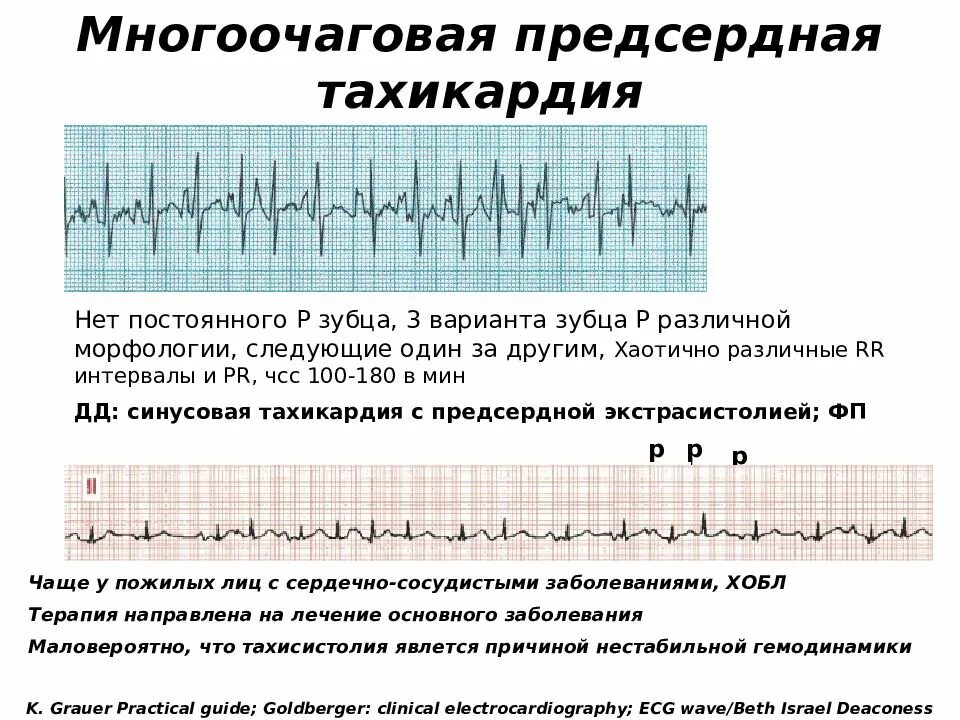 Пароксизмальная наджелудочковая тахикардия экг. Экг-критерии пароксизмальной предсердной тахикардии. Атриовентрикулярная пароксизмальная тахикардия на экг. Очаговая предсердная тахикардия на экг. Фокусная предсердная тахикардия.