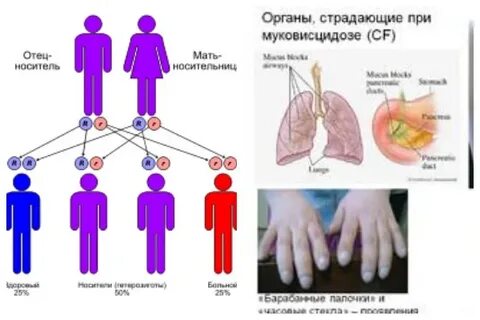 Клинические особенности муковисцидоза у детей старшего возраста