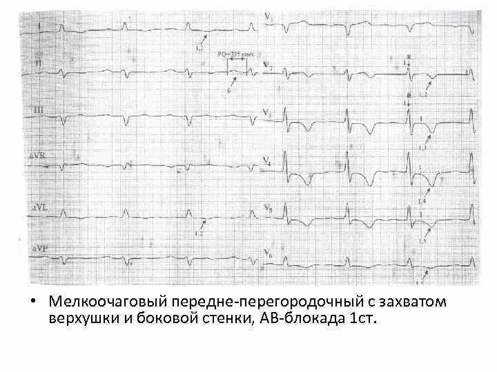 Изменение миокарда передне перегородочной области. Инфаркт миокарда передней перегородки на ЭКГ. Мелкоочаговый инфаркт миокарда на ЭКГ. Мелкоочаговый инфаркт на ЭКГ. Передне-перегородочный с захватом верхушки инфаркт миокарда на ЭКГ.