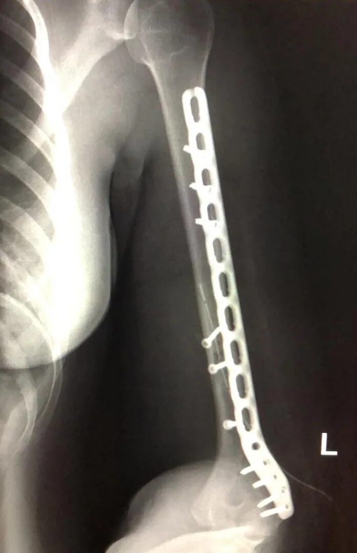 Репозиционный остеосинтез. Остеосинтез бедра пластиной рентген. Накостный остеосинтез бедра рентген. Остеосинтез перелома плечевой кости. Остеосинтез операция пластины