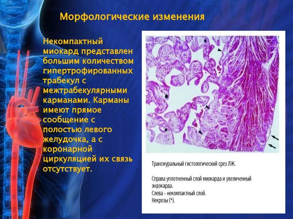 Морфологические изменения болезни. Никомпактный миокардит. Хорологические изменения. Морфологические изменения миокарда.