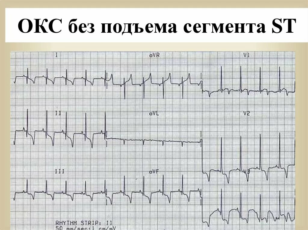 Острым коронарным синдромом без. Окс c подъемом сегмента ст ЭКГ. Острый коронарный синдром ЭКГ. ЭКГ инфаркт миокарда без подъема St. ЭКГ без подъема сегмента St.