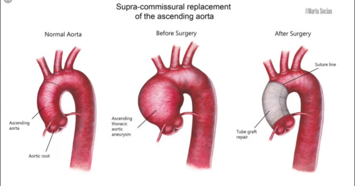 Аневризма восходящей аорты операция. Операция Бенталла де Боно ход операции. Аорта. Протез восходящего отдела аорты.