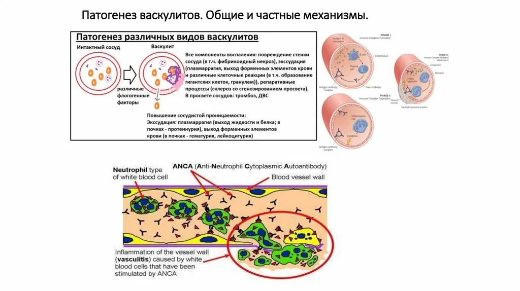 Системные васкулиты патогенез. Геморрагический васкулит патогенез схема. Системные васкулиты патогенез схема. Системные васкулиты этиология. Васкулит патогенез