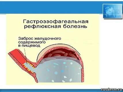 Негативный гэрб