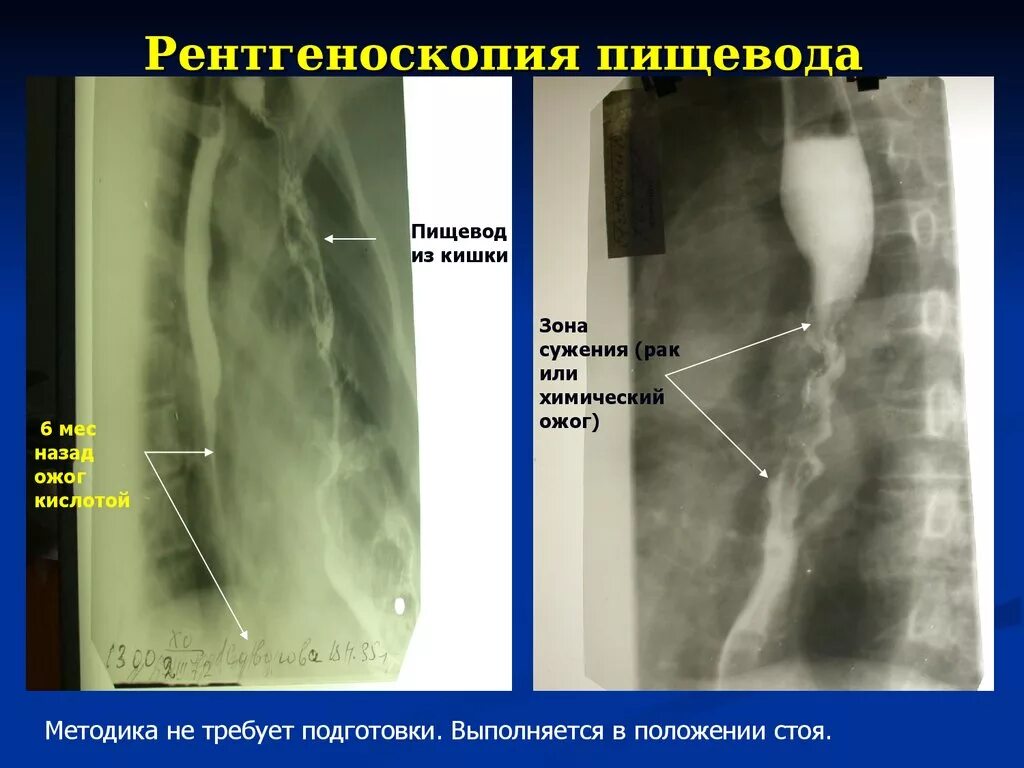 Просвет пищевода