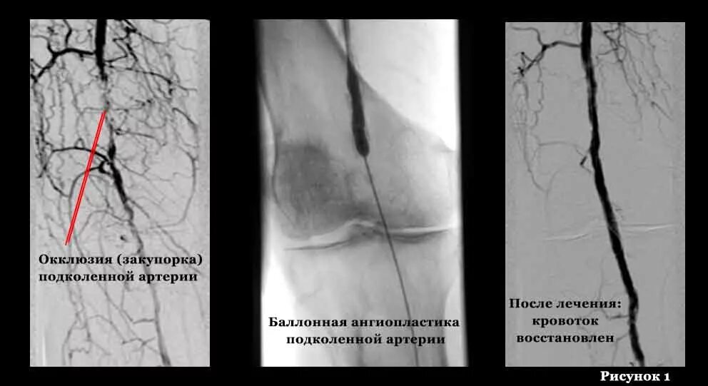 Операция на артерии нижних