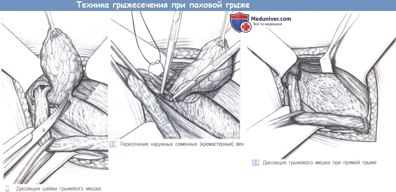 Грыжесечение ущемленной грыжи. Грыжесечение при паховой грыже. Операции грыжече грыжесечение. Лапароскопическая операция грыжесечение.