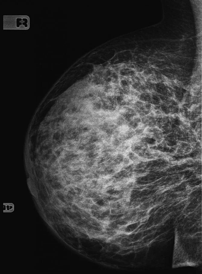 Диффузная форма рака молочной железы. Диффкщные формы ракамолочной д. Диффузная форма рака молочной железы. Инфильтративная опухоль молочной железы. Диффузная форма рака молочной железы.