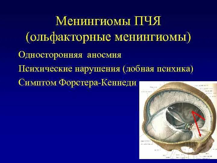 Сообщения передней черепной ямки. Менингиома передней черепной ямки мрт. менингиомы ольфакторной ямки. опухоль передней черепной ямки. менингиома ольфакторной ямки кт.
