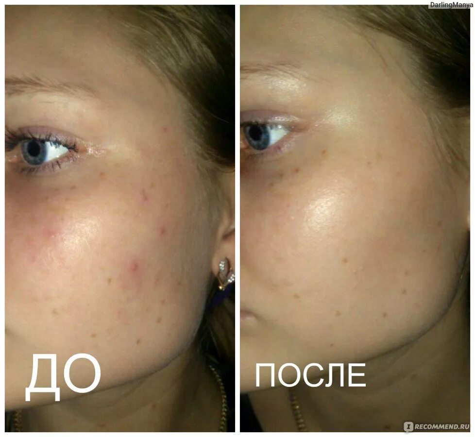 Можно применять и после. Пилинг джесснера поверхностный. Мазь от боли в спине. Как принимать до еды или после. Афобазол показания и противопоказания.