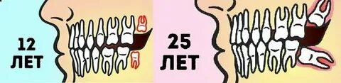 Во сне вытащил зуб руками