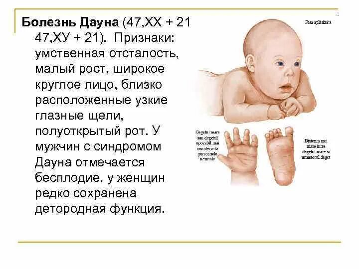 Синдром Дауна проявление заболевания. Характерные признаки проявления болезни синдрома Дауна. Симптомы синдрома Дауна у младенца. Болезни с синдромом Дауна симптомы. Степени дауна